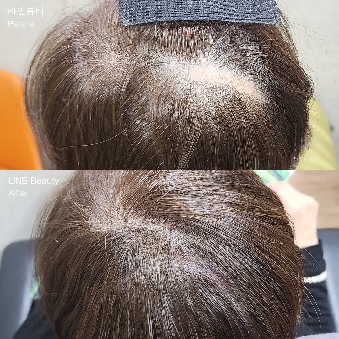 수술자국을 두피커버문신으로 가려드려요(SMP)