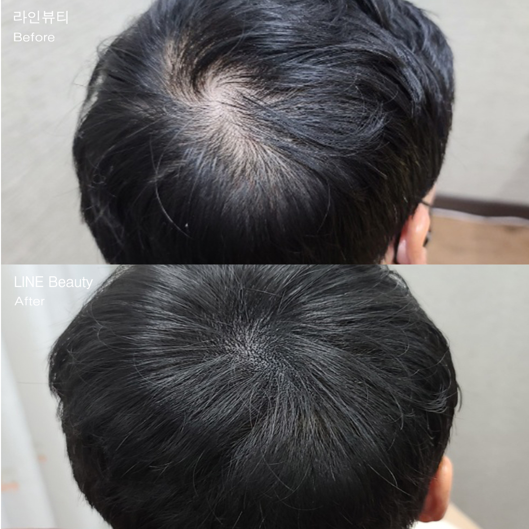 자연스러운 두피커버문신