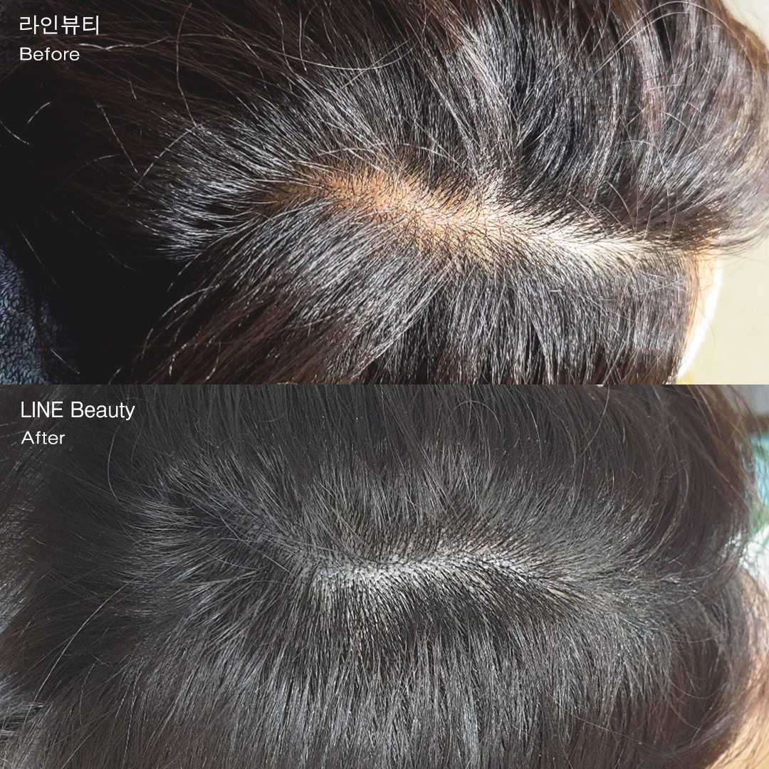 비어보이는 가르마 두피커버문신