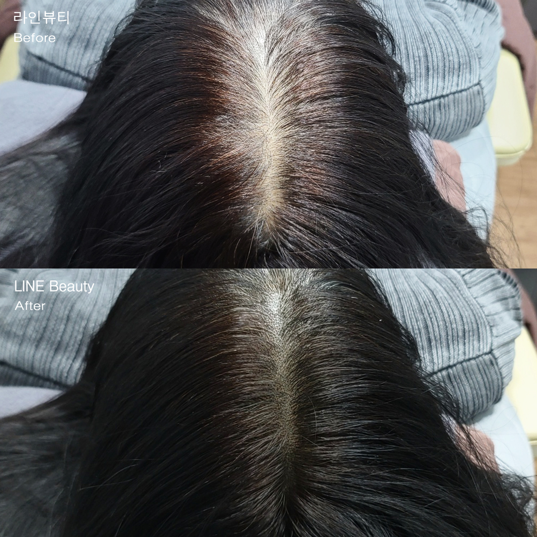 자연스러운가르마 두피커버문신