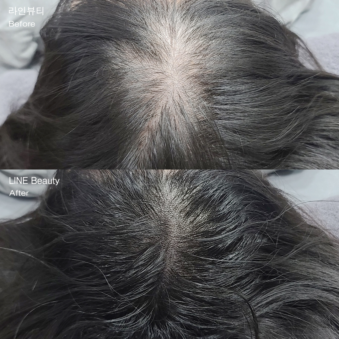 정수리 탈모 두피커버문신으로 고민 해결!