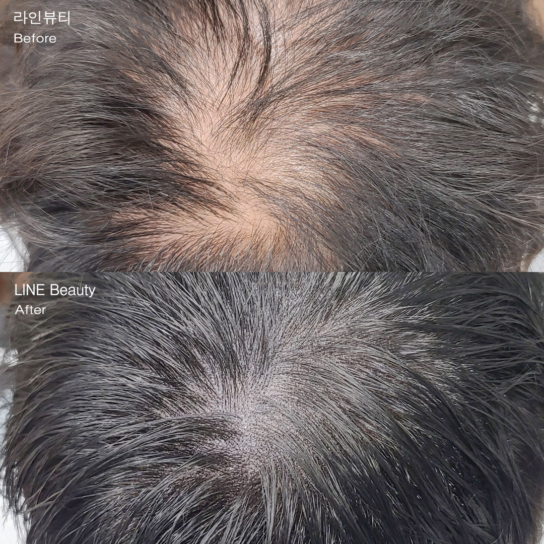 정수리가 비워보이는 탈모, SMP두피커버 문신으로 고민 해결!  